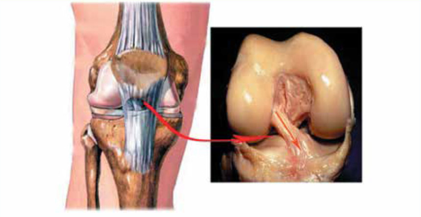 Иллюстрация и фото передней крестообразной связки коленного сустава