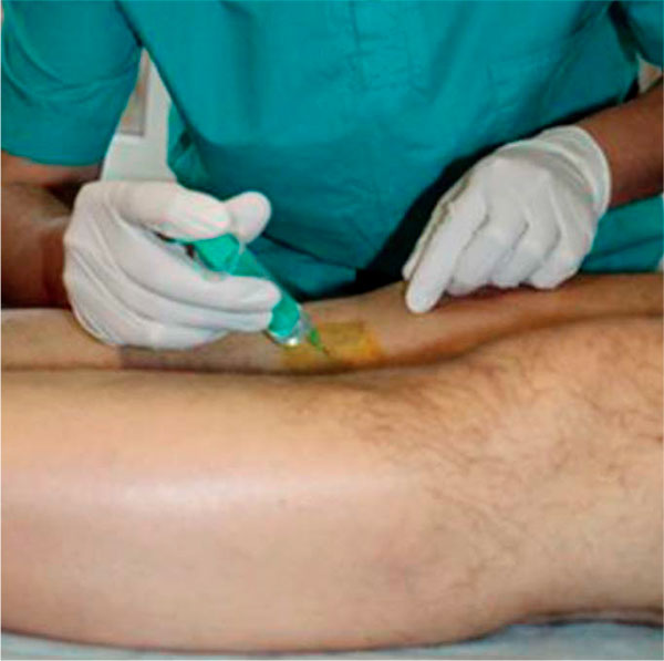 Рисунок 12. Методика перифокальных инъекций в область «гусиной лапки» коленного сустава